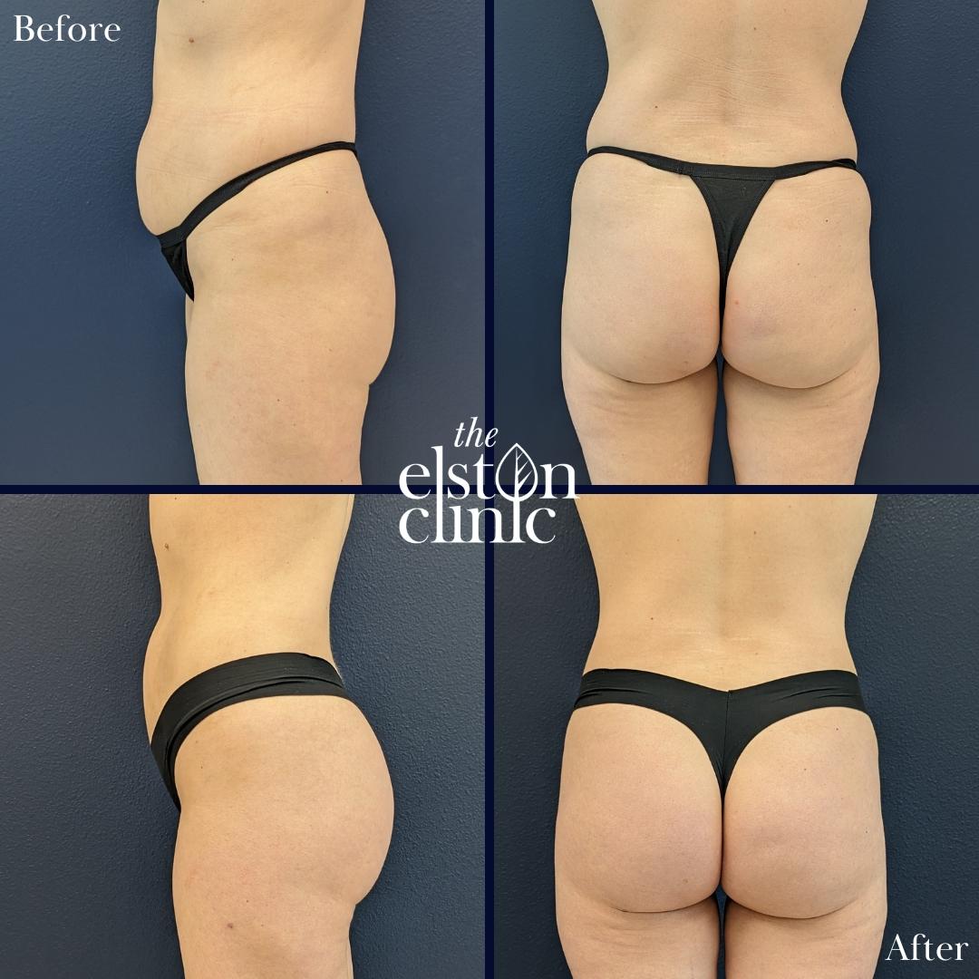 Before and after images of a patient who underwent skinny BBL for gluteal enhancement.