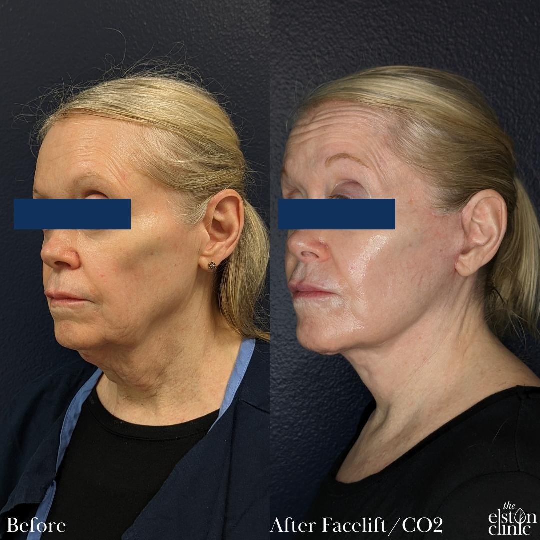 Before and after of a CO2 laser resurfacing treatment at the Elston Clinic