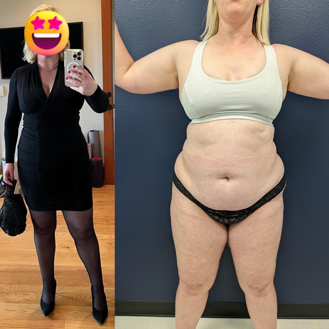 Before and after images of a patient with lipedema that underwent liposuction and now can wear dresses that fit better